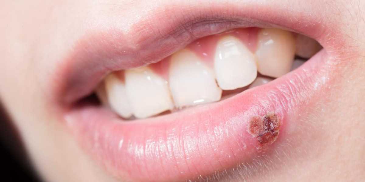Cold Sore Patches for Faster Cold Sore Relief