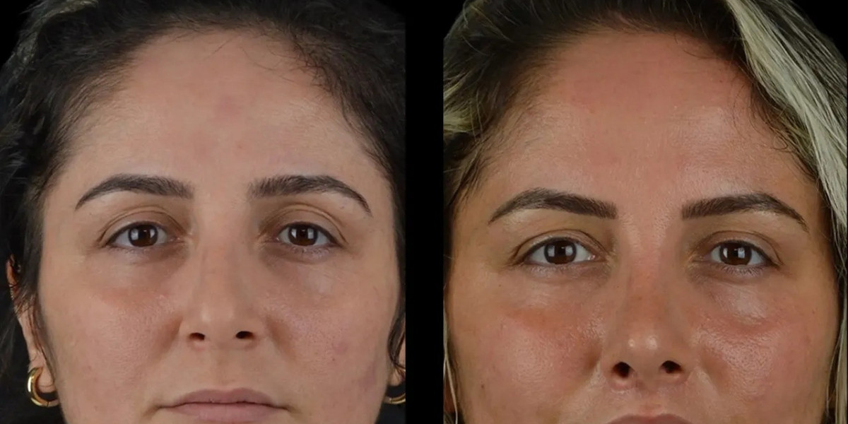 Cheek Fillers Treatments in Dubai for Soft and Natural Results