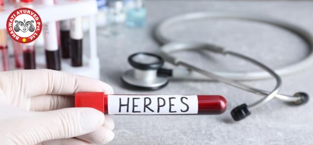 Herpes Simplex Treatment in Telangana - Bhagwati Ayurved