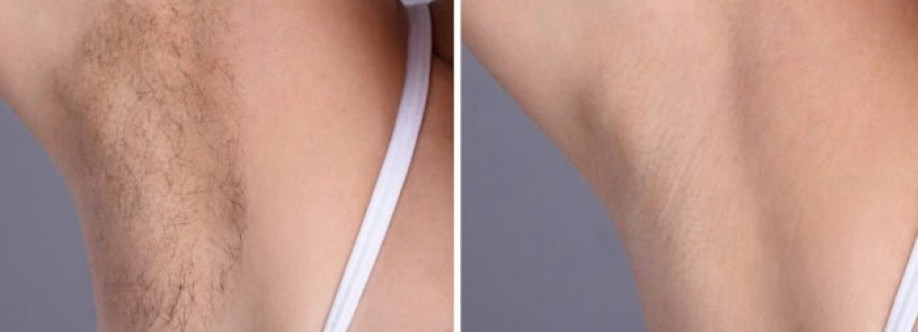 Laser Hair Removal Cover Image