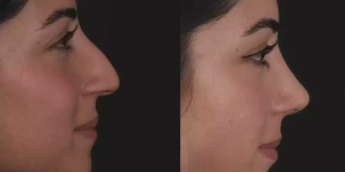 Septoplasty in Dubai Guided by Specialized Surgeons