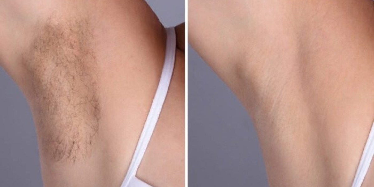 Best Plastic Surgeons in dubai for Laser Hair Removal with Minimal Side Effects