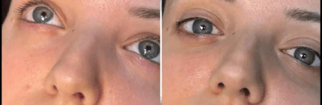 dermal fillers Cover Image