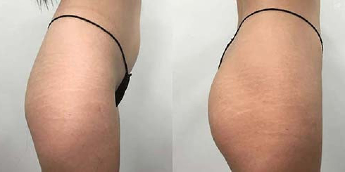 Accentuate Feminine Lines Smoothly Using Butt & Body Fillers