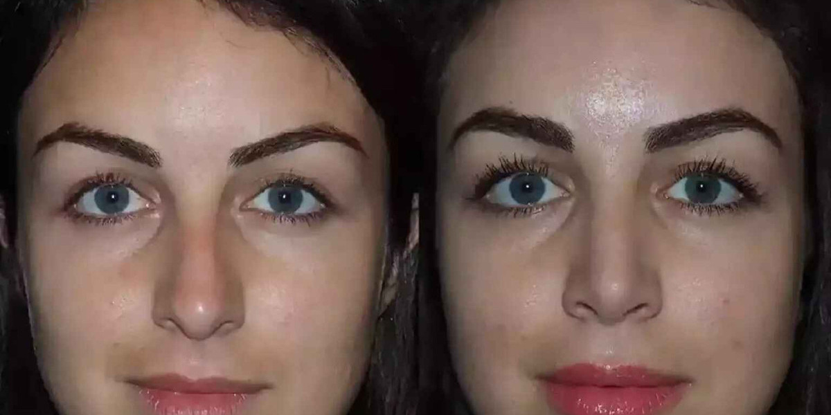 Septoplasty in Dubai: Treatment, Recovery, and Results