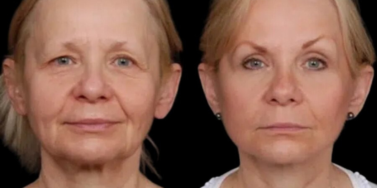 The Best Clinics for Under Eye Fillers Treatments in Dubai