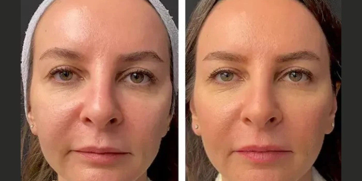 Best Plastic Surgeon in dubai Perform Advanced Mesotherapy for Skin Rejuvenation