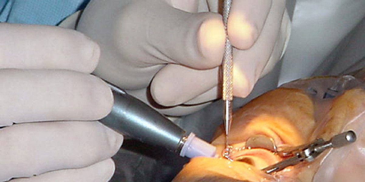 Seeing Clearly Again: A Comprehensive Guide to Modern Cataract Surgery