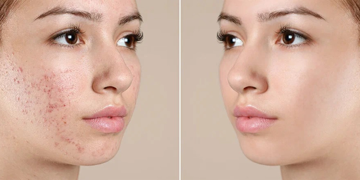 Skin Transformation Through Acne Treatment in Islamabad