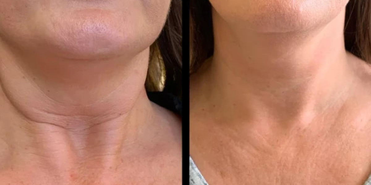 Best Aesthetic Clinics in Dubai for Ethical Profhilo Medicine