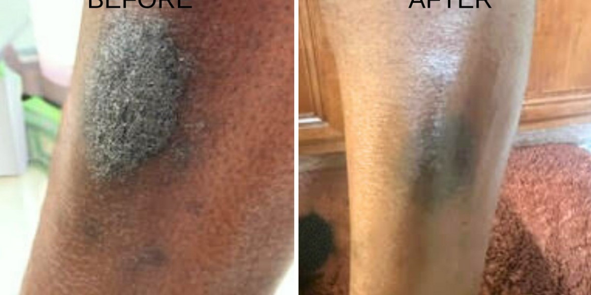 Gentle Skin Recovery After Surgery Without Irritation Guide