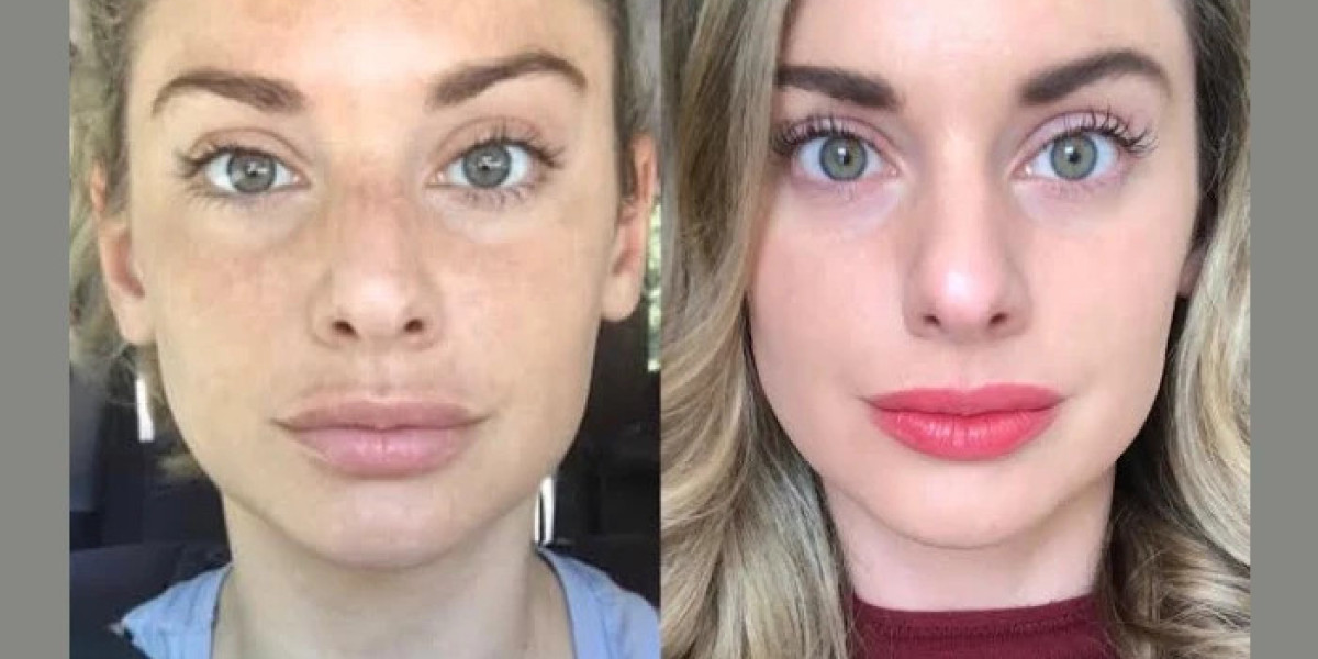 Achieve Youthful Skin with Best Plastic Surgeons in Dubai for RF Microneedling