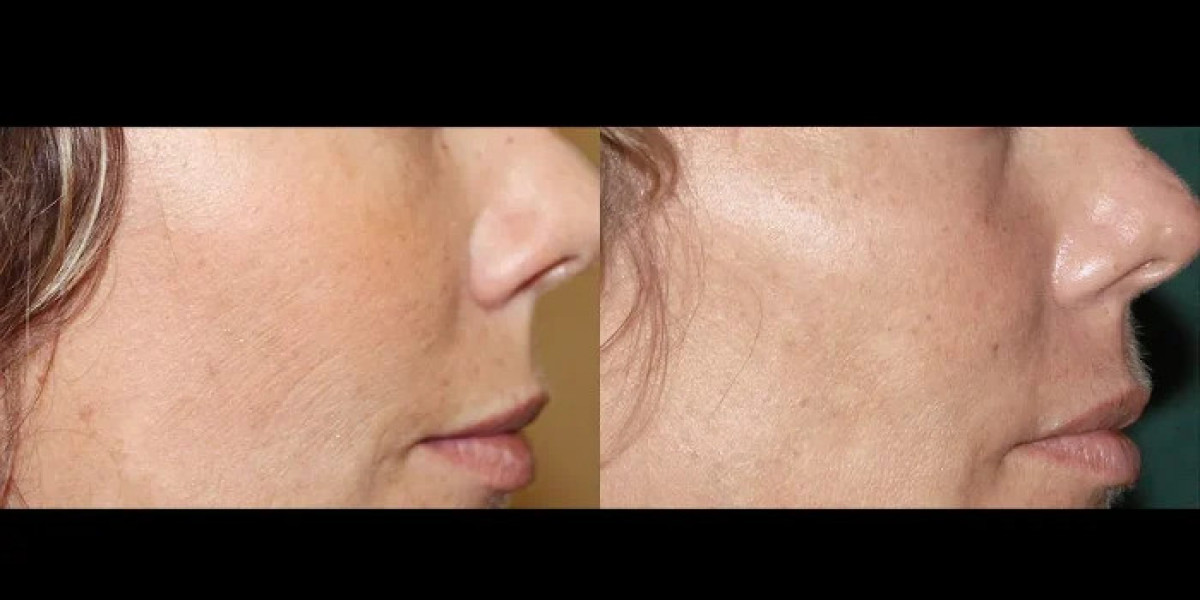Fractional Microneedling for Wrinkle Reduction by Best Plastic Surgeons in dubai