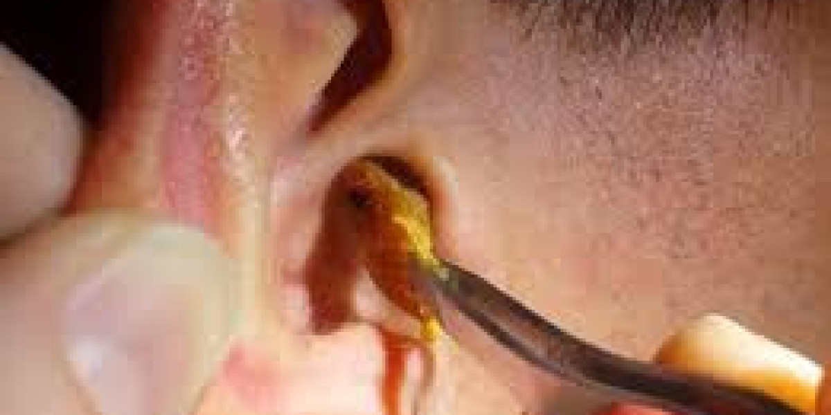 The Hidden Dangers of Ignoring Ear Wax Buildup