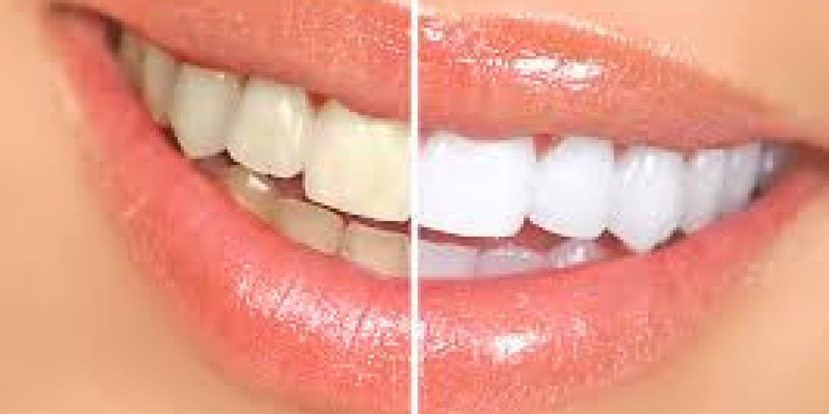 How to Safely Whiten Your Teeth Without Damaging Enamel